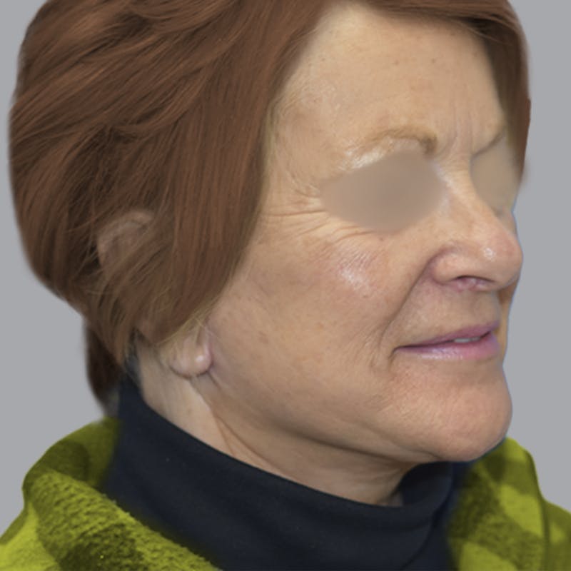 Facelift and Neck Lift Before & After Gallery - Patient 413920 - Image 6