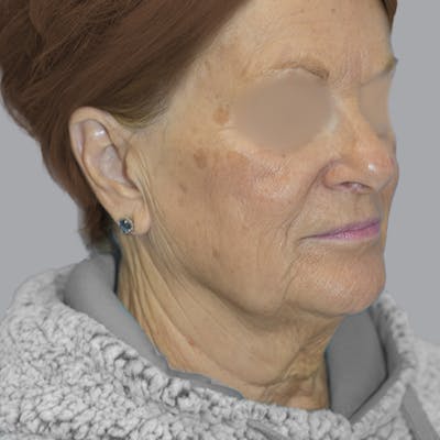 Facelift and Neck Lift Before & After Gallery - Patient 413920 - Image 5