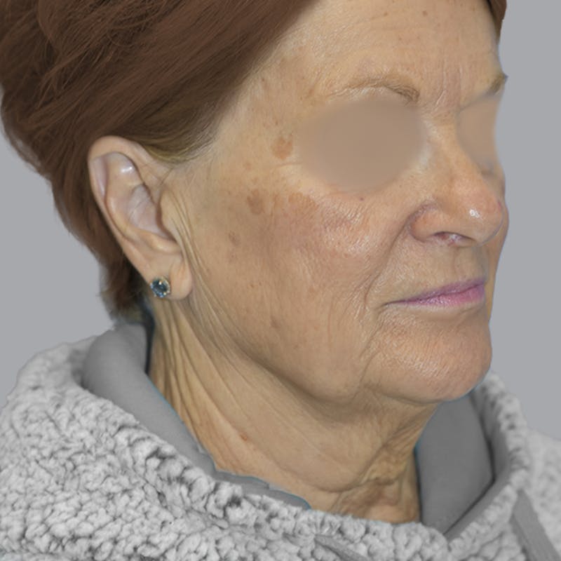 Facelift and Neck Lift Before & After Gallery - Patient 413920 - Image 5