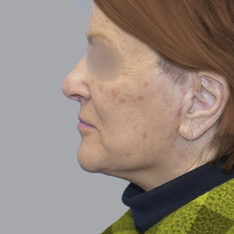 Facelift and Neck Lift Before & After Gallery - Patient 413920 - Image 8