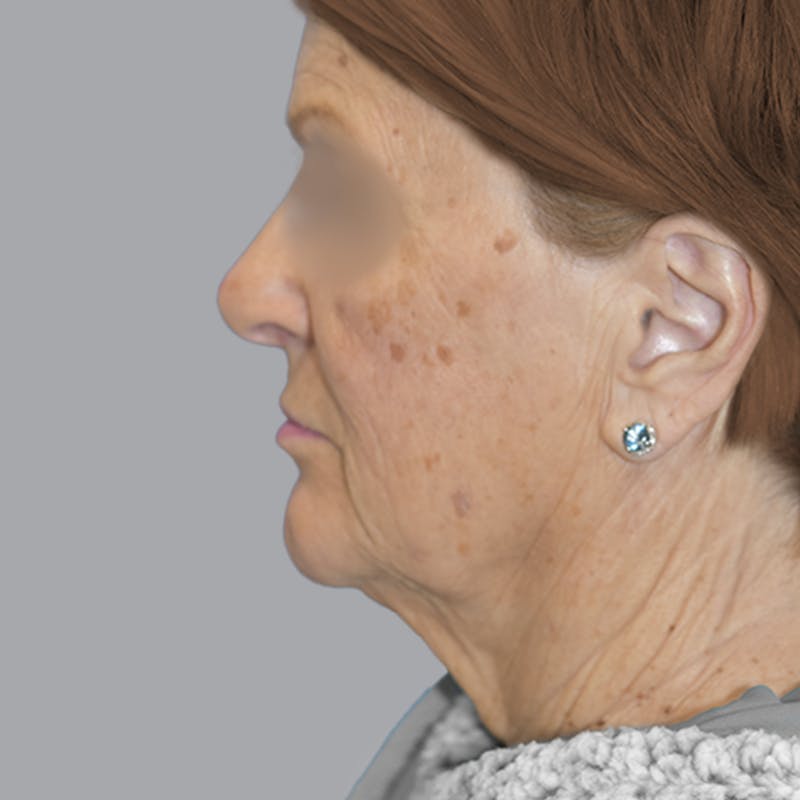 Facelift and Neck Lift Before & After Gallery - Patient 413920 - Image 7