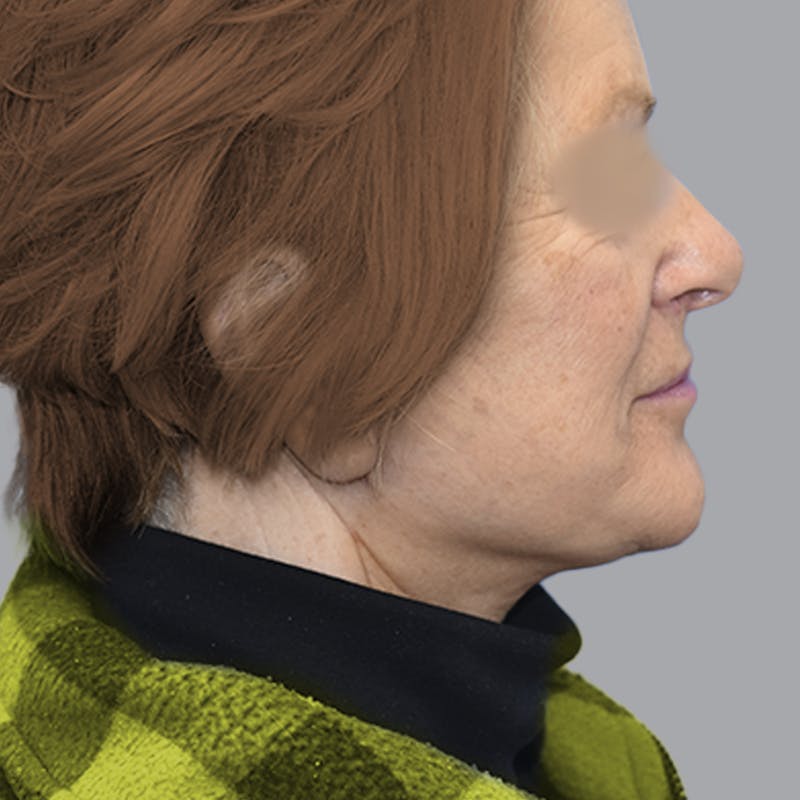 Facelift and Neck Lift Before & After Gallery - Patient 413920 - Image 10