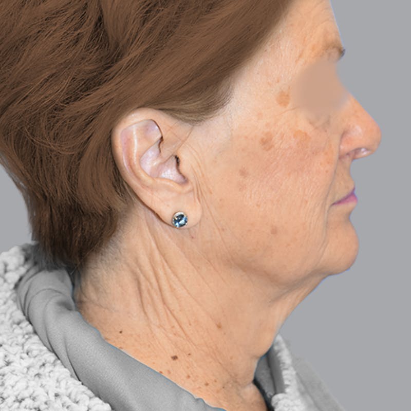Facelift and Neck Lift Before & After Gallery - Patient 413920 - Image 9