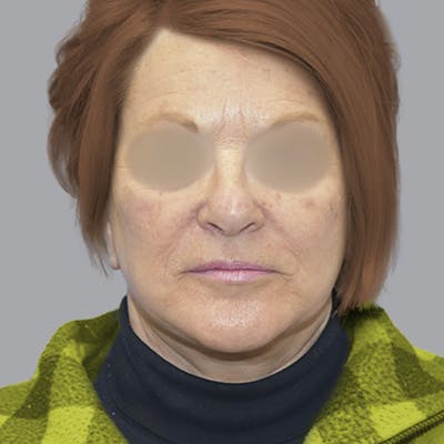 Facelift and Neck Lift Before & After Gallery - Patient 413920 - Image 2