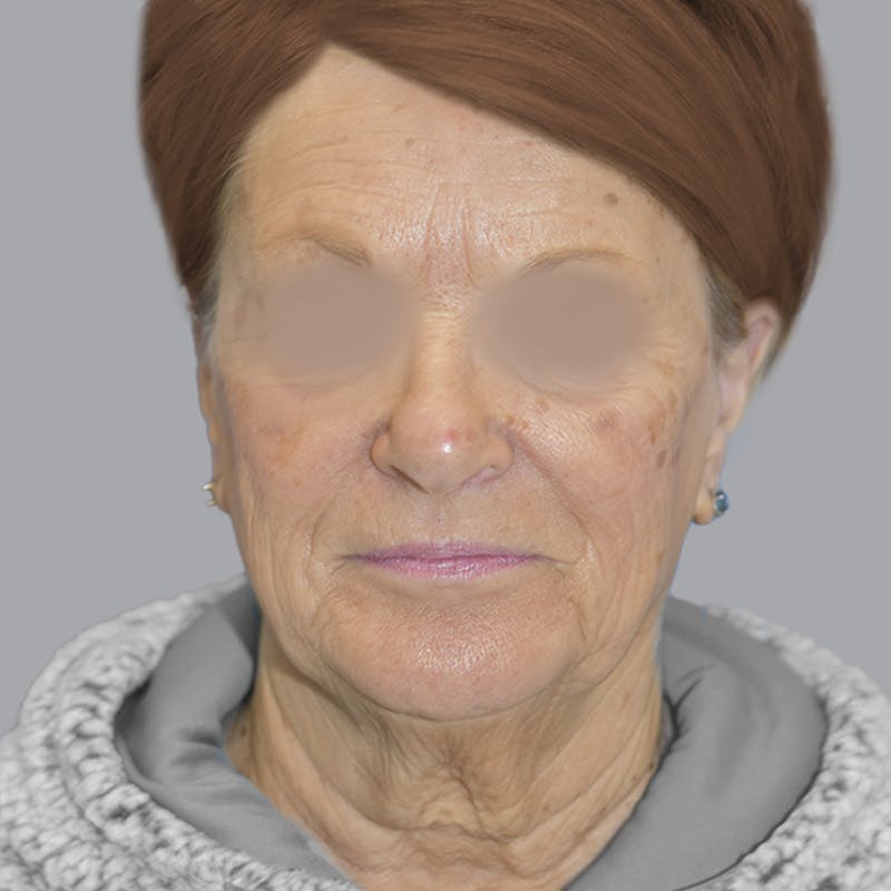 Facelift and Neck Lift Before & After Gallery - Patient 413920 - Image 1