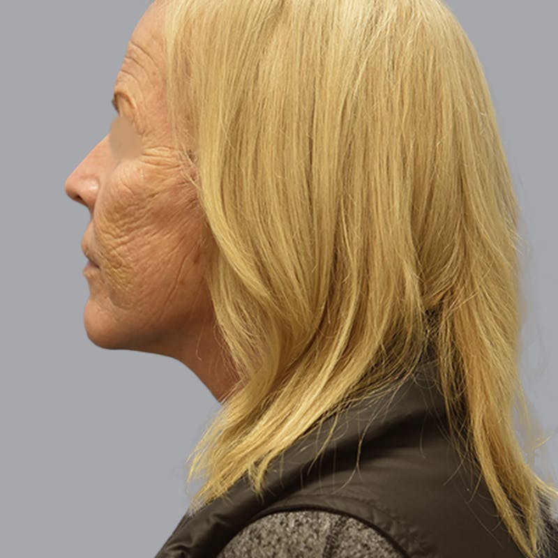Facelift and Neck Lift Before & After Gallery - Patient 170897 - Image 10