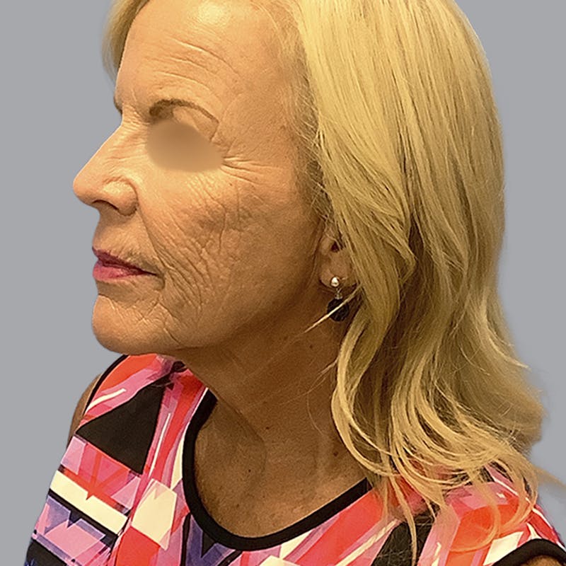 Facelift and Neck Lift Before & After Gallery - Patient 170897 - Image 7