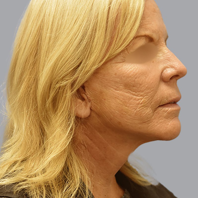 Facelift and Neck Lift Before & After Gallery - Patient 170897 - Image 4