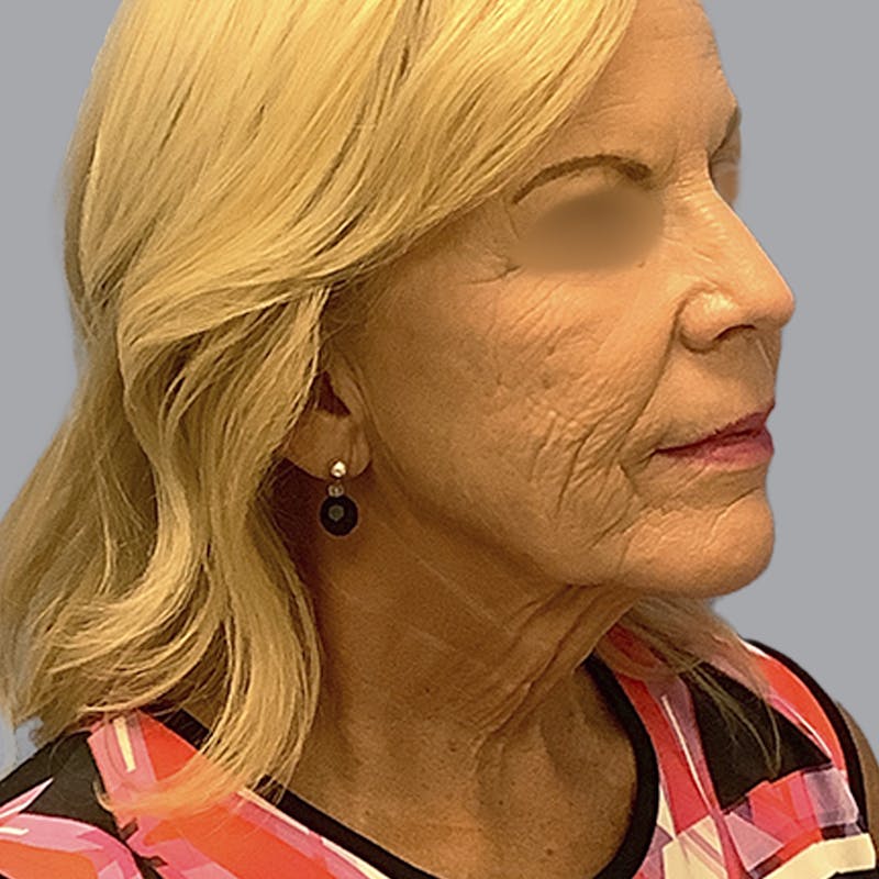 Facelift and Neck Lift Before & After Gallery - Patient 170897 - Image 3
