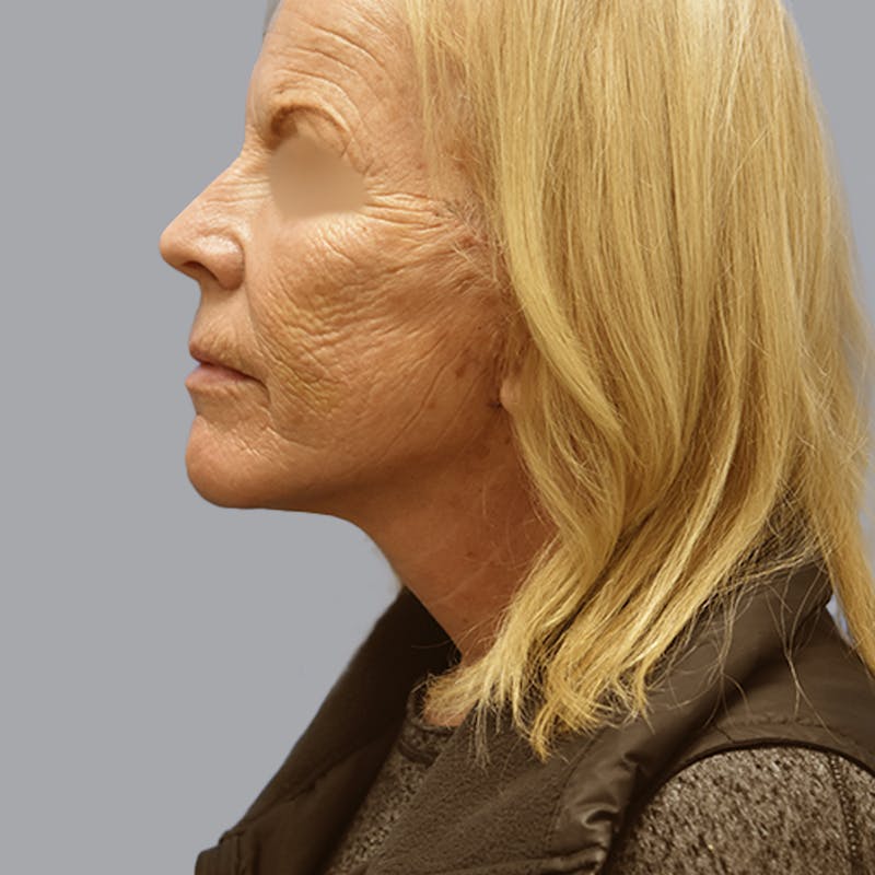 Facelift and Neck Lift Before & After Gallery - Patient 170897 - Image 8