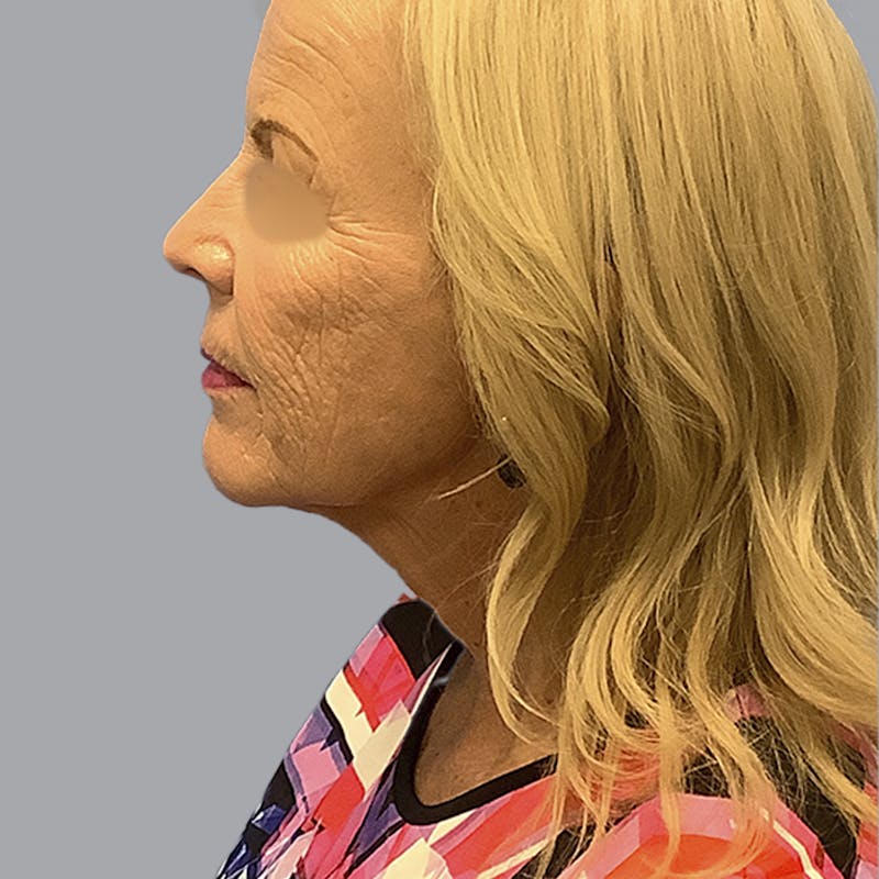 Facelift and Neck Lift Before & After Gallery - Patient 170897 - Image 9