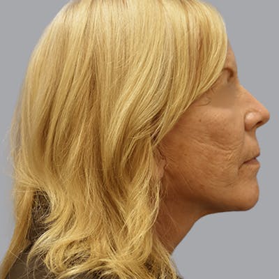 Facelift and Neck Lift Before & After Gallery - Patient 170897 - Image 6