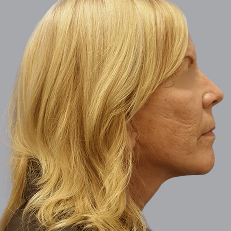 Facelift and Neck Lift Before & After Gallery - Patient 170897 - Image 6