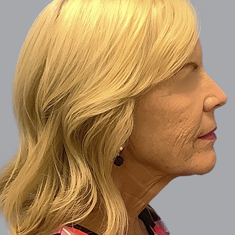 Facelift and Neck Lift Before & After Gallery - Patient 170897 - Image 5