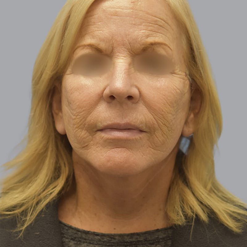 Facelift and Neck Lift Before & After Gallery - Patient 170897 - Image 2