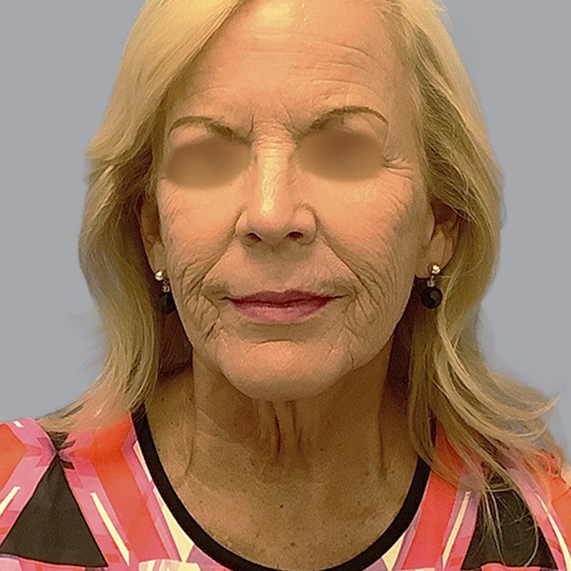 Facelift and Neck Lift Before & After Gallery - Patient 170897 - Image 1