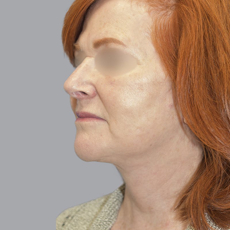 Facelift and Neck Lift Before & After Gallery - Patient 419302 - Image 4