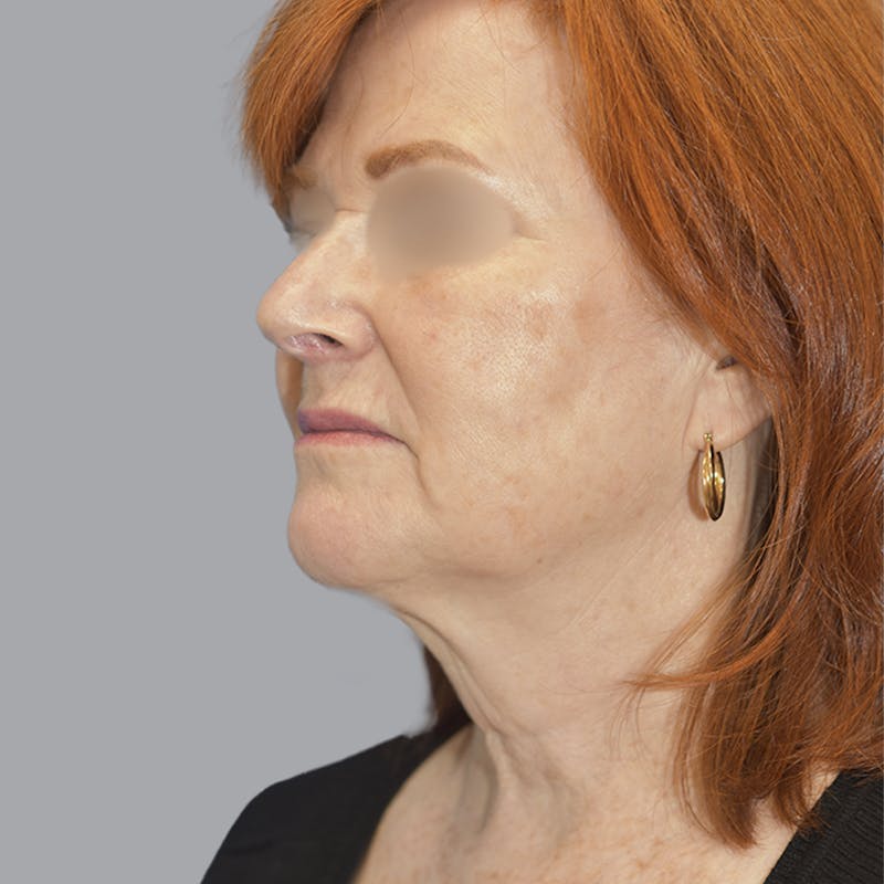 Facelift and Neck Lift Before & After Gallery - Patient 419302 - Image 3