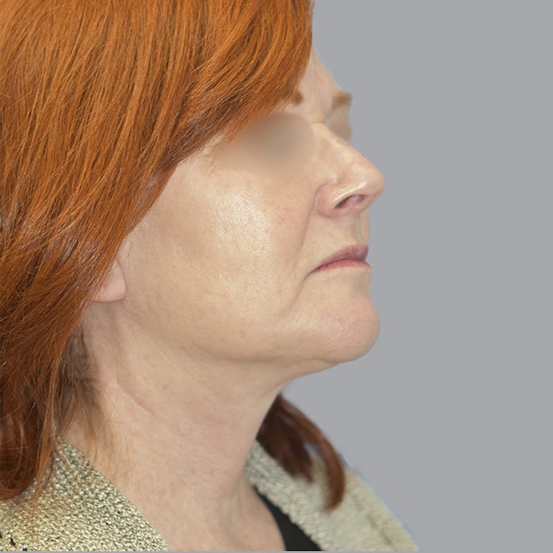 Facelift and Neck Lift Before & After Gallery - Patient 419302 - Image 6