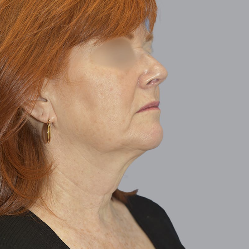 Facelift and Neck Lift Before & After Gallery - Patient 419302 - Image 5