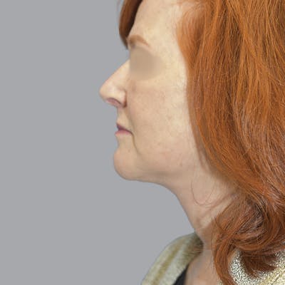 Facelift and Neck Lift Before & After Gallery - Patient 419302 - Image 6