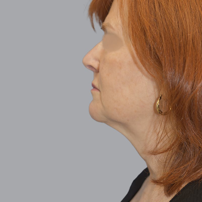 Facelift and Neck Lift Before & After Gallery - Patient 419302 - Image 5