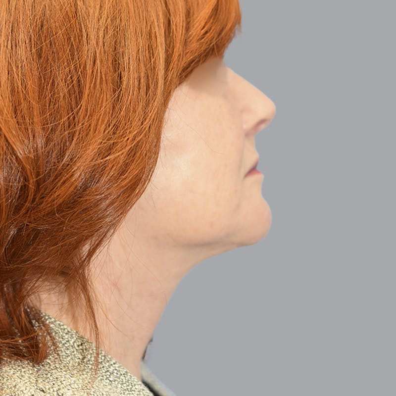 Facelift and Neck Lift Before & After Gallery - Patient 419302 - Image 10