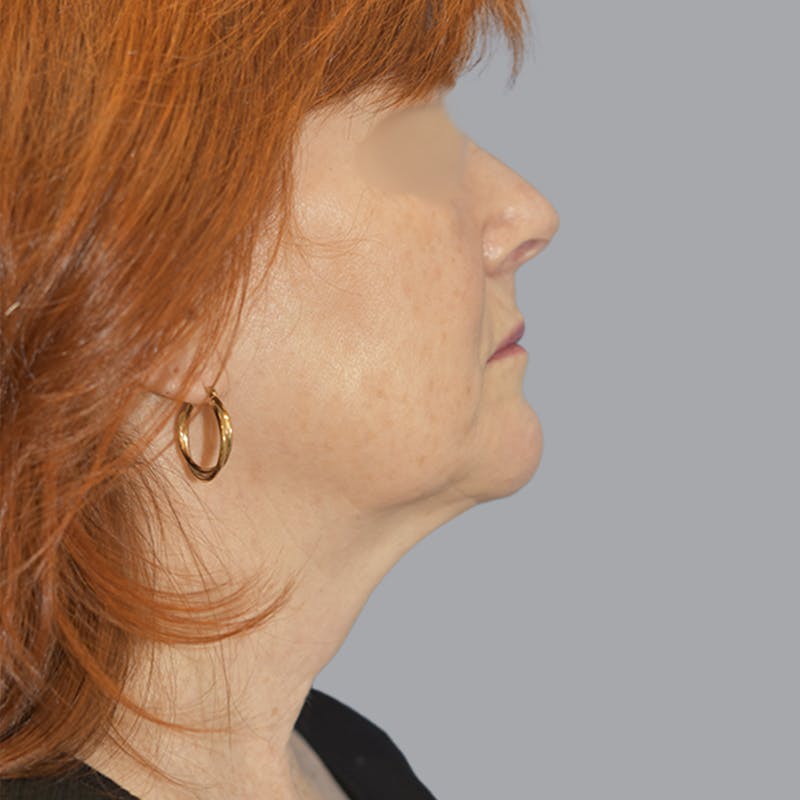 Facelift and Neck Lift Before & After Gallery - Patient 419302 - Image 9