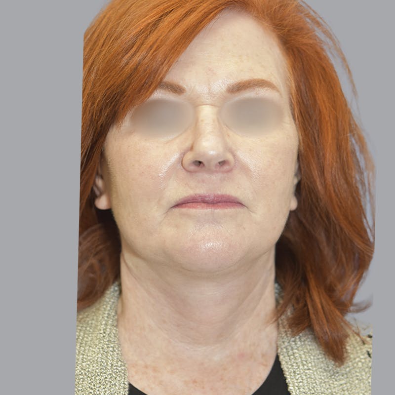Facelift and Neck Lift Before & After Gallery - Patient 419302 - Image 2
