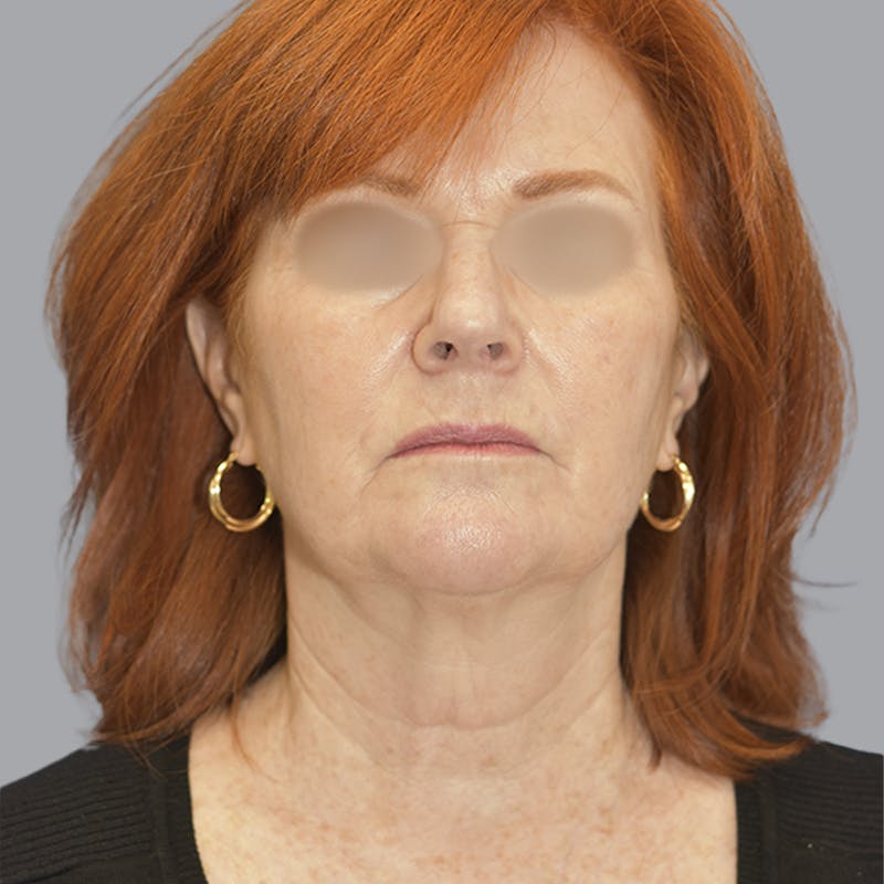 Facelift and Neck Lift Before & After Gallery - Patient 419302 - Image 1