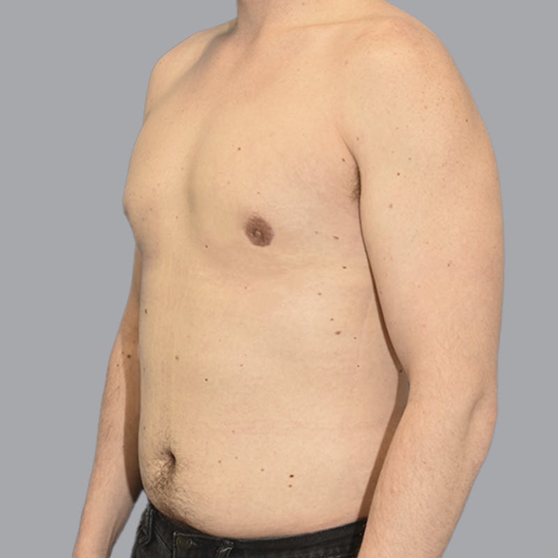 Gynecomastia Before & After Gallery - Patient 415394 - Image 6