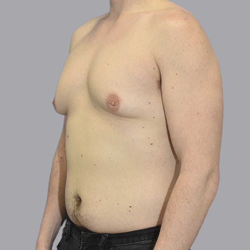 Gynecomastia Before & After Gallery - Patient 415394 - Image 5