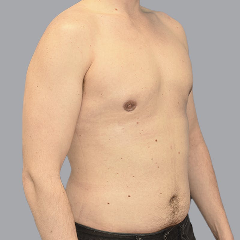 Gynecomastia Before & After Gallery - Patient 415394 - Image 4