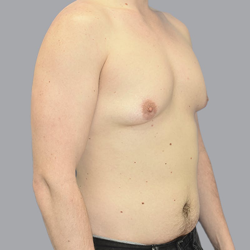 Gynecomastia Before & After Gallery - Patient 415394 - Image 3