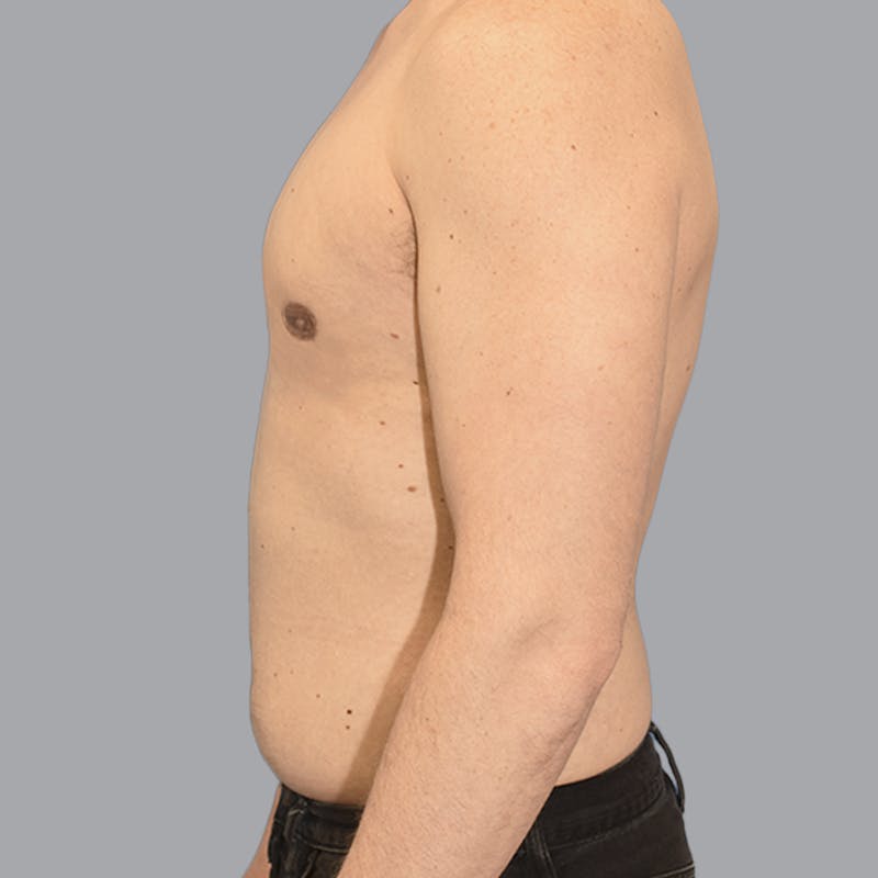 Gynecomastia Before & After Gallery - Patient 415394 - Image 8