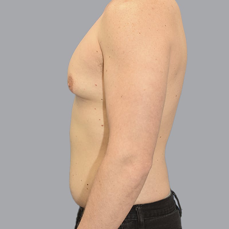 Gynecomastia Before & After Gallery - Patient 415394 - Image 7