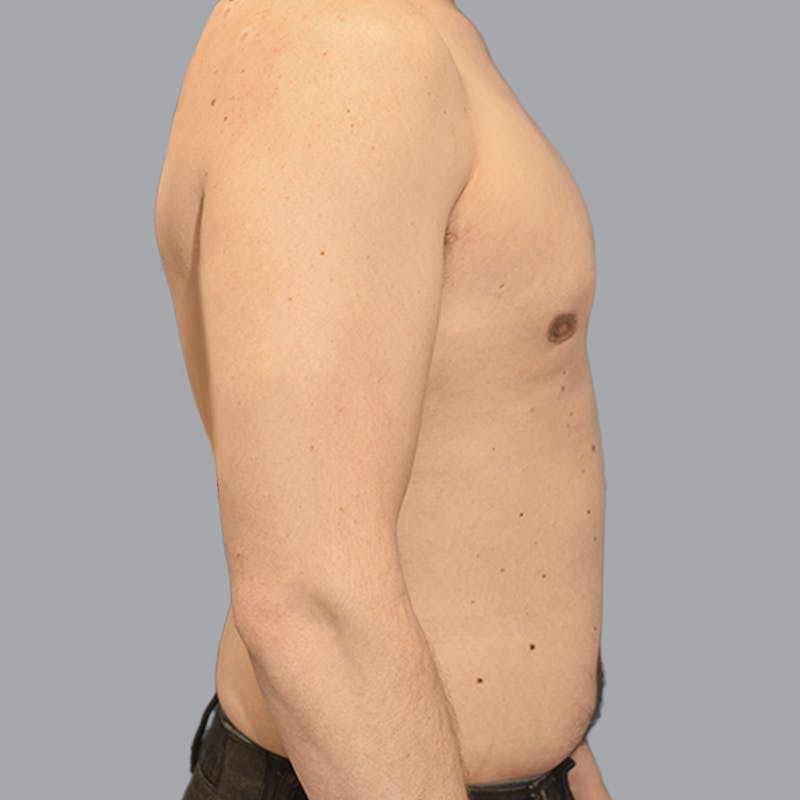 Gynecomastia Before & After Gallery - Patient 415394 - Image 10