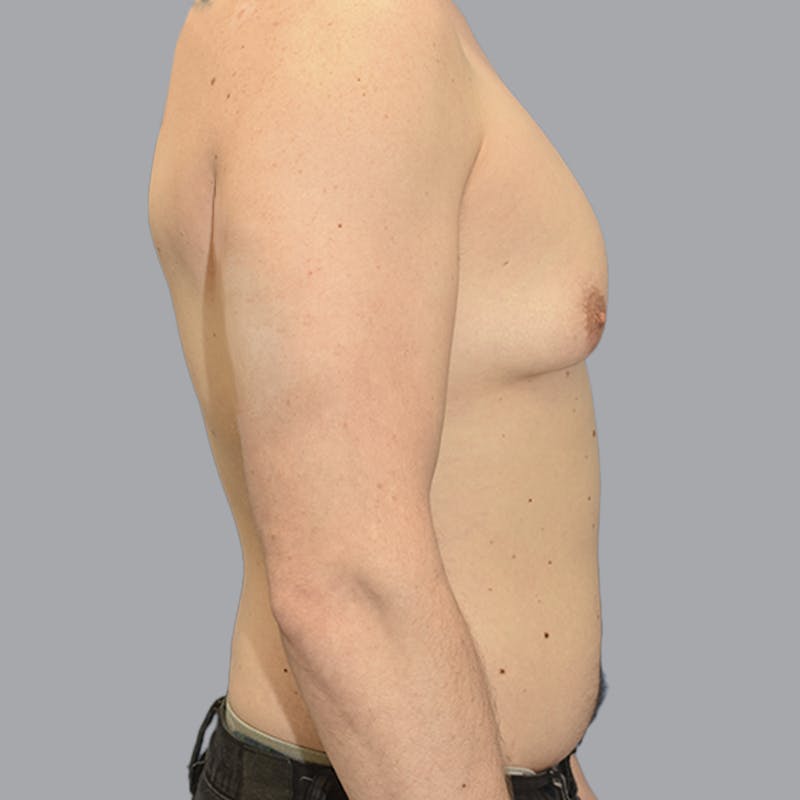 Gynecomastia Before & After Gallery - Patient 415394 - Image 9