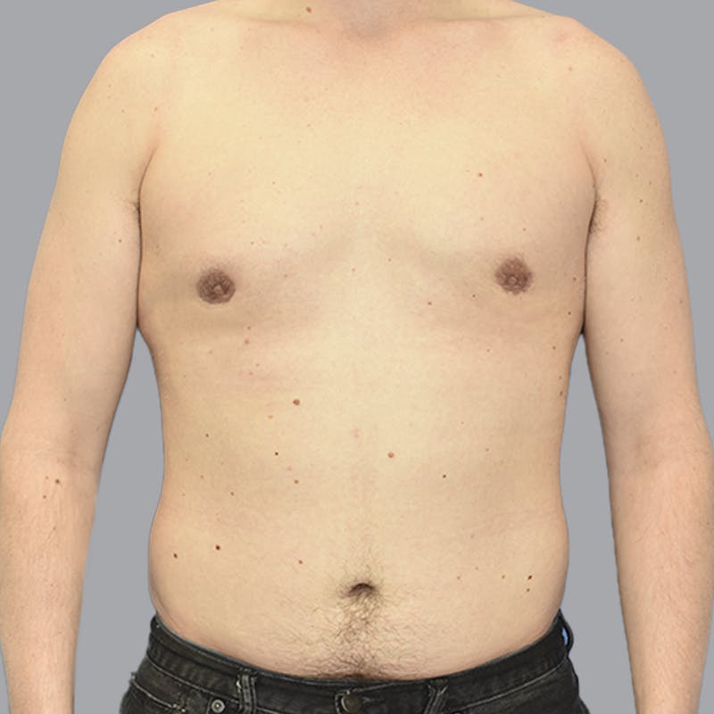 Gynecomastia Before & After Gallery - Patient 415394 - Image 2