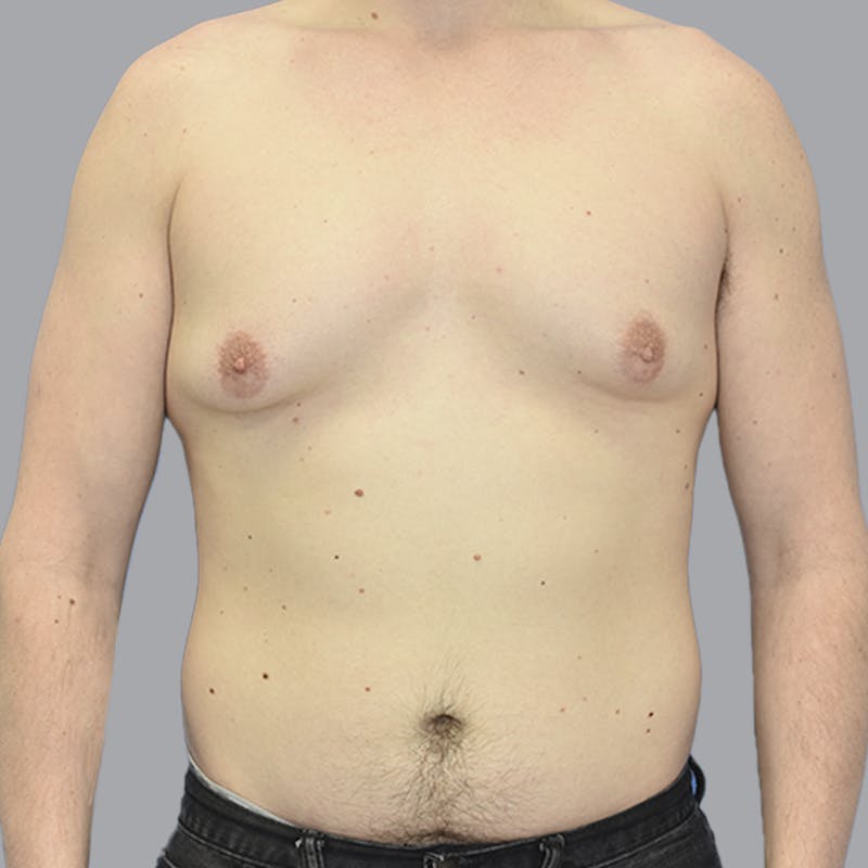 Gynecomastia Before & After Gallery - Patient 415394 - Image 1