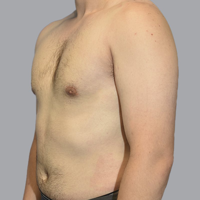 Gynecomastia Before & After Gallery - Patient 252447 - Image 6
