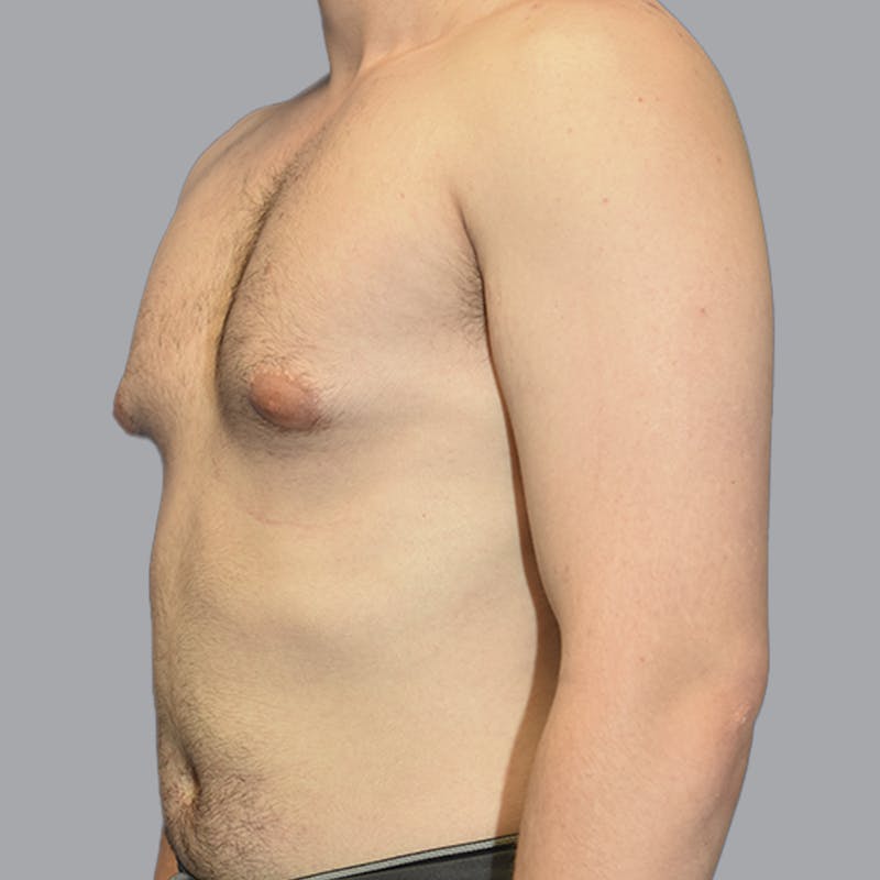 Gynecomastia Before & After Gallery - Patient 252447 - Image 5