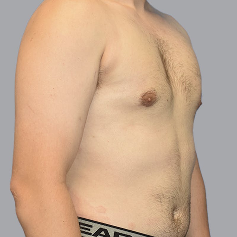 Gynecomastia Before & After Gallery - Patient 252447 - Image 4