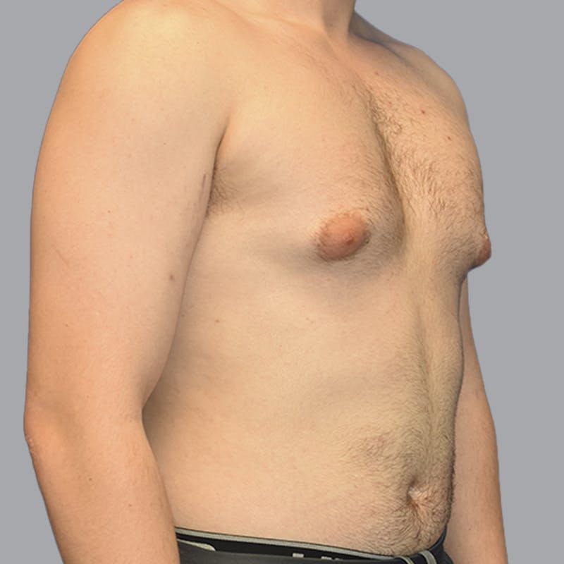 Gynecomastia Before & After Gallery - Patient 252447 - Image 3