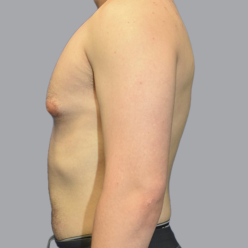 Gynecomastia Before & After Gallery - Patient 252447 - Image 7