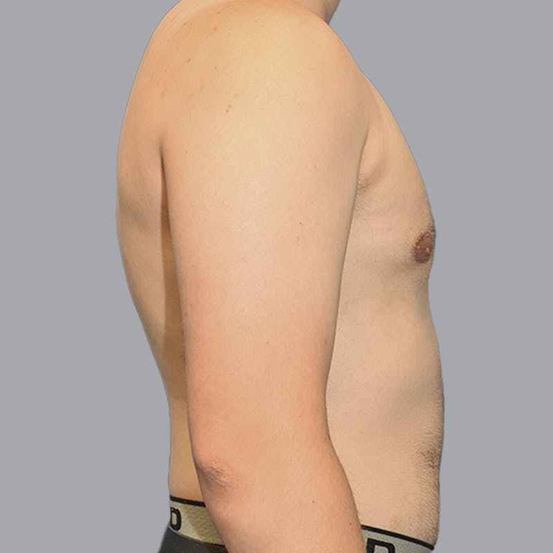 Gynecomastia Before & After Gallery - Patient 252447 - Image 10
