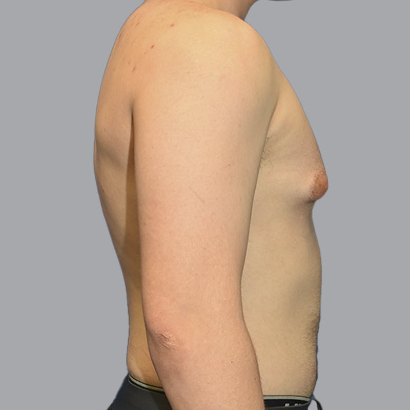 Gynecomastia Before & After Gallery - Patient 252447 - Image 9