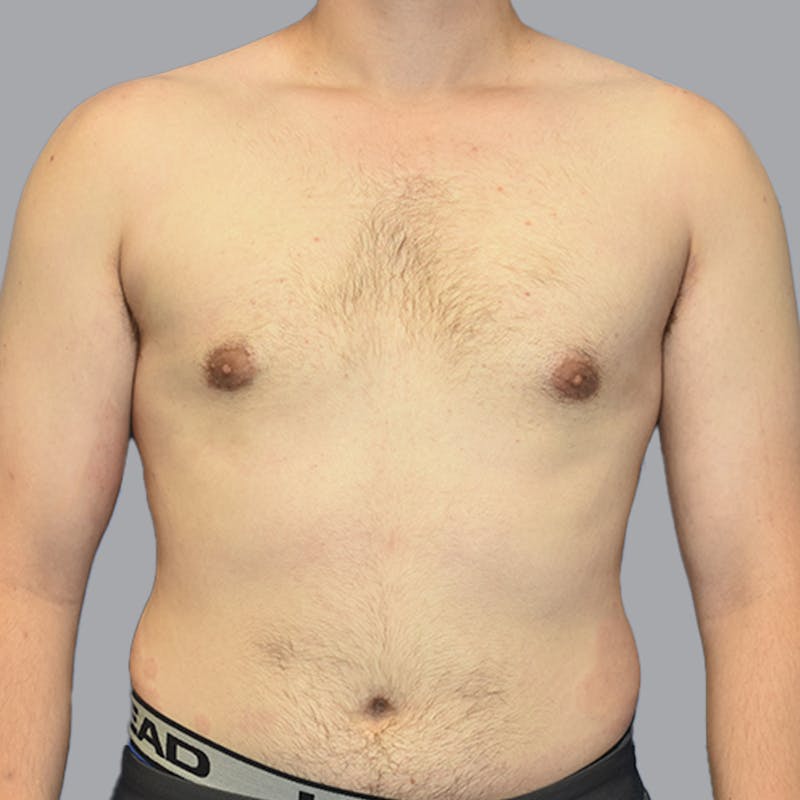 Gynecomastia Before & After Gallery - Patient 252447 - Image 2