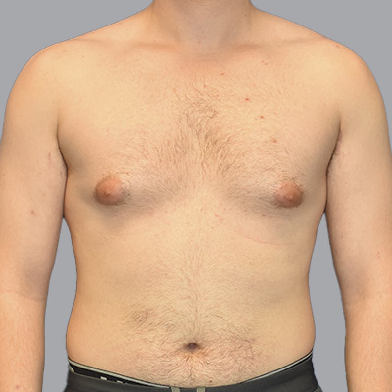Gynecomastia Before & After Gallery - Patient 252447 - Image 1