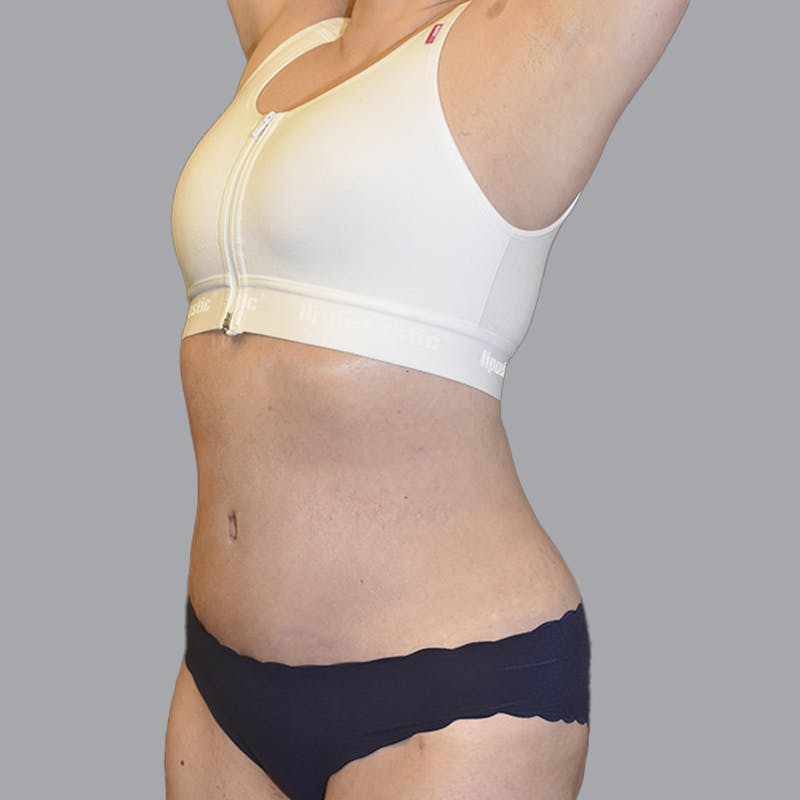 Abdominoplasty Before & After Gallery - Patient 474408 - Image 6